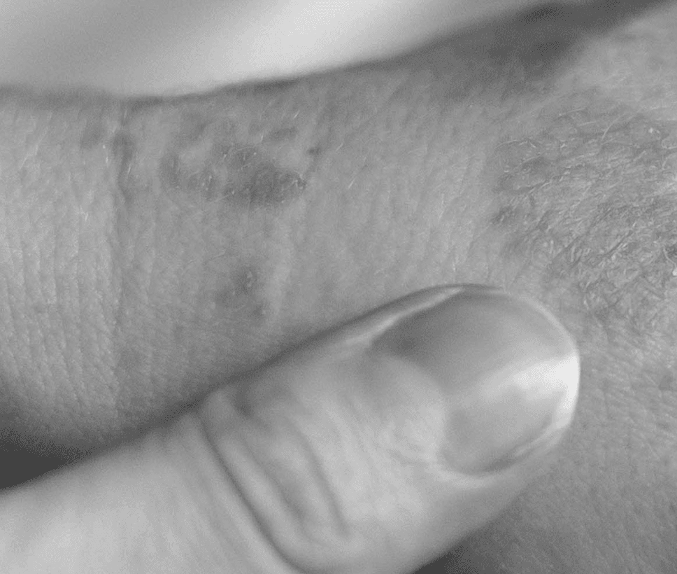SCAR REVISION