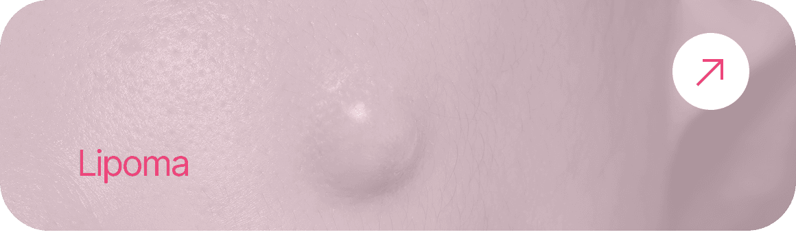 Lipoma