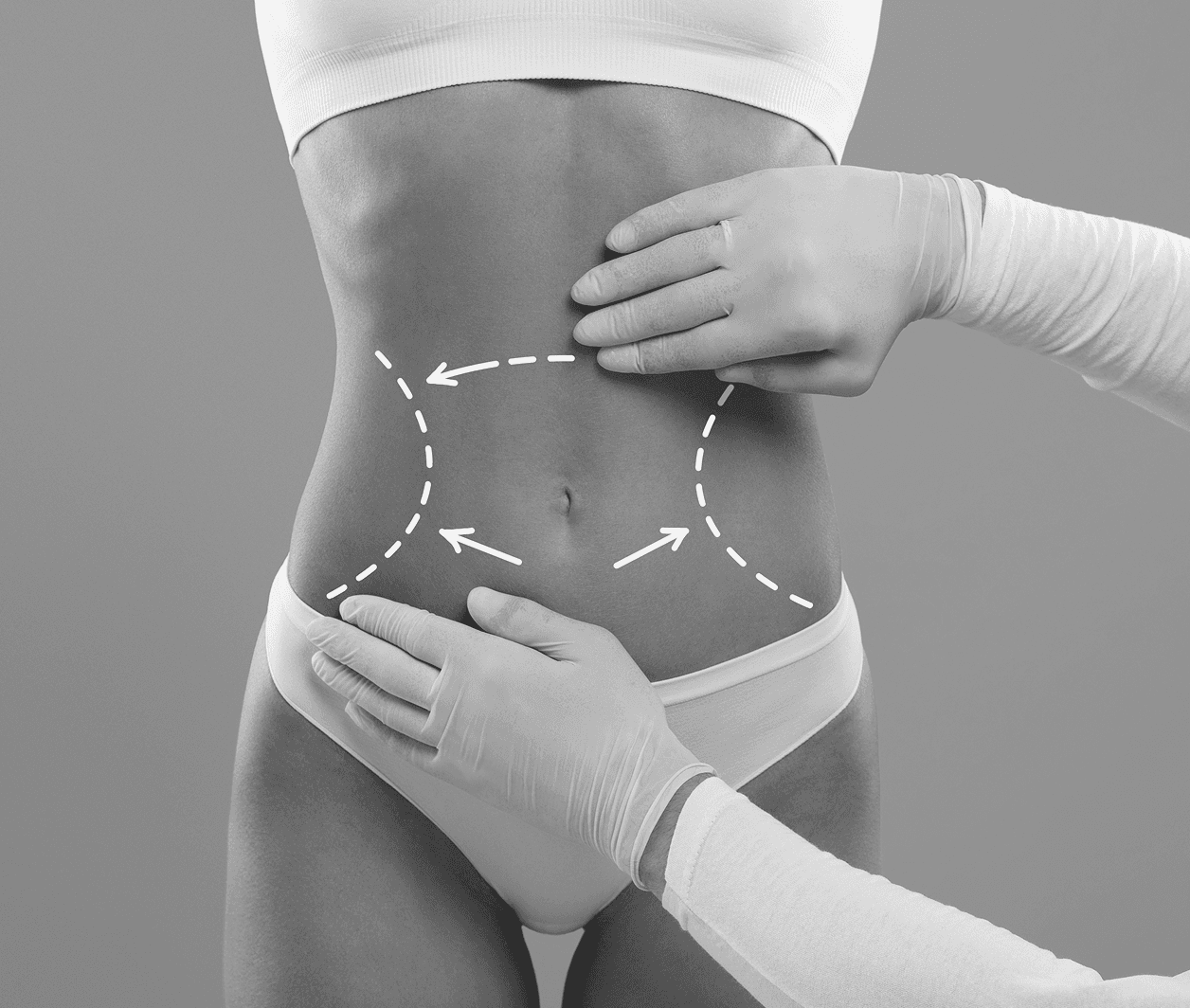Liposuction
