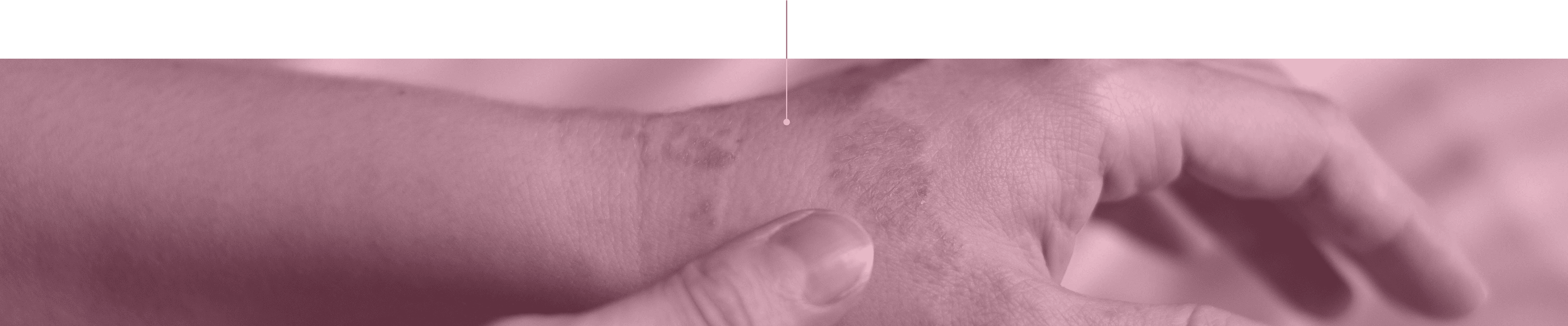 SCAR RESOLUTION