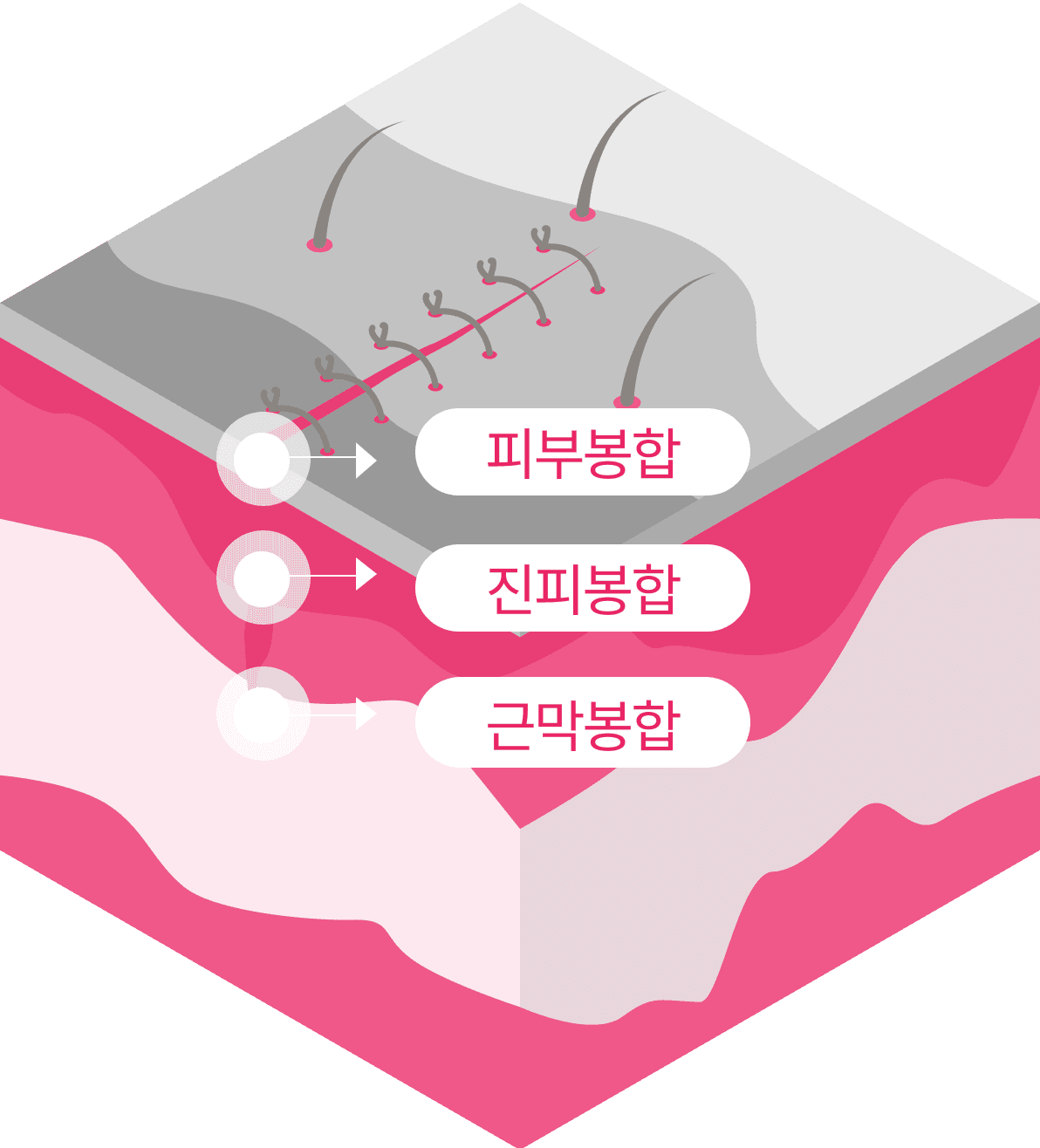 상처봉합