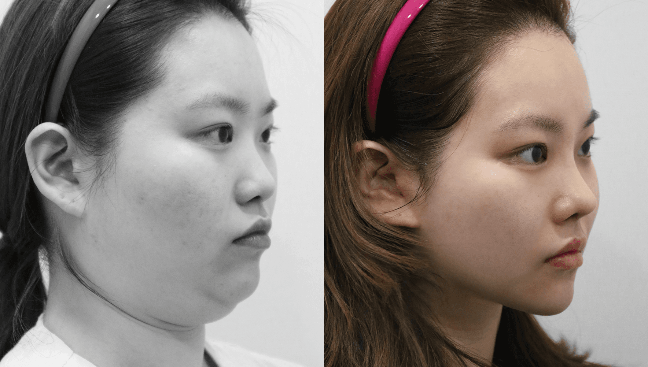 before-after-3